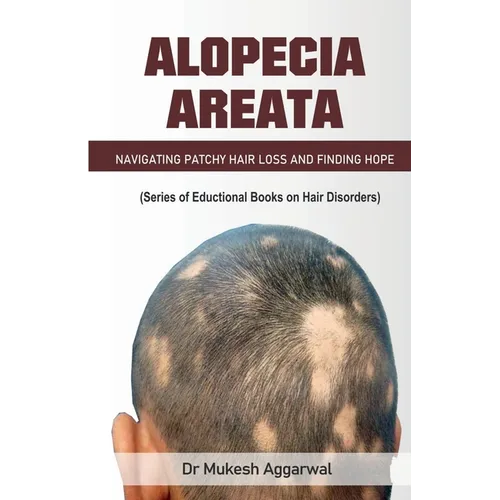 Alopecia Areata